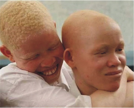 Albinism and myths surrounding them
